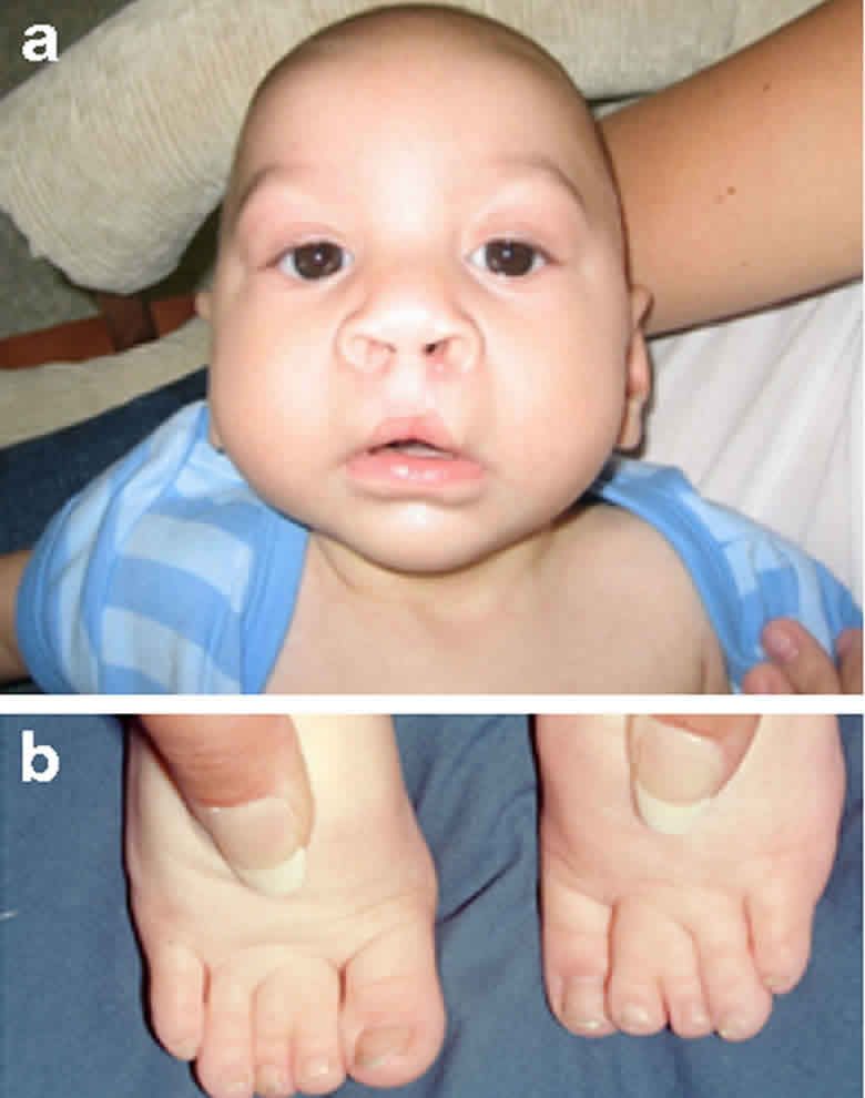 Smith-Lemli-Opitz-Syndrom: Was ist das, Symptome, Behandlung, Prognose