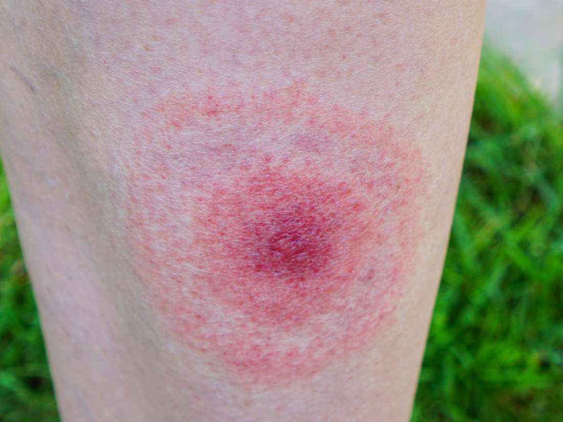 Lyme-Borreliose: Was es ist, Ursachen, Symptome, Behandlung