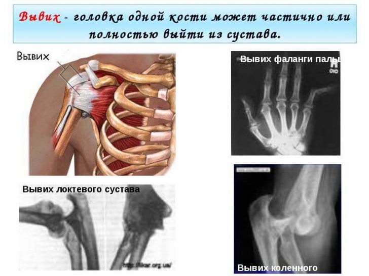 Luxation Gelenk: Symptome und Behandlung