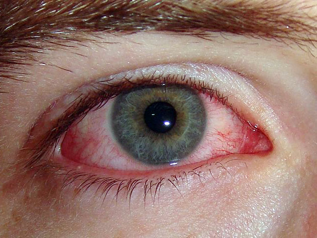 Allergy to the eyes: symptoms and treatment (compresses, drugs)