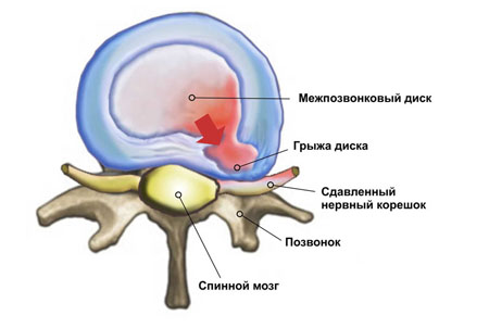 Schmerzen im Nacken und Lendenwirbel Osteochondrose