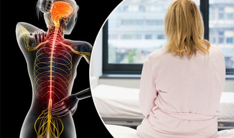 Ankyloserande spondylit hos kvinnor: symptom och behandling, prognos för livet