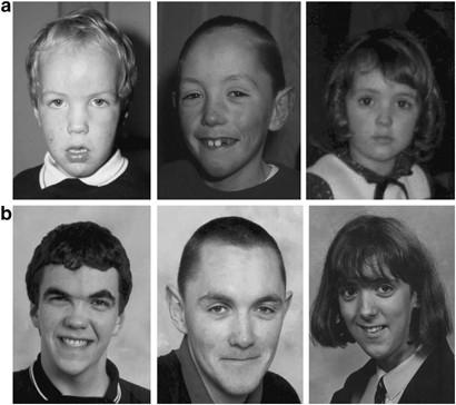 Sotos-Syndrom bei Kindern: Was ist das, Symptome, Fotos, Behandlung, Prognose