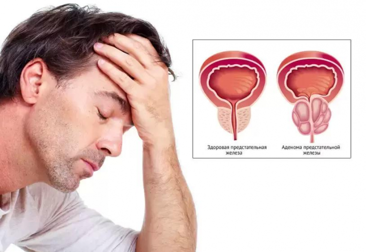BPH: symptom, orsaker, behandling