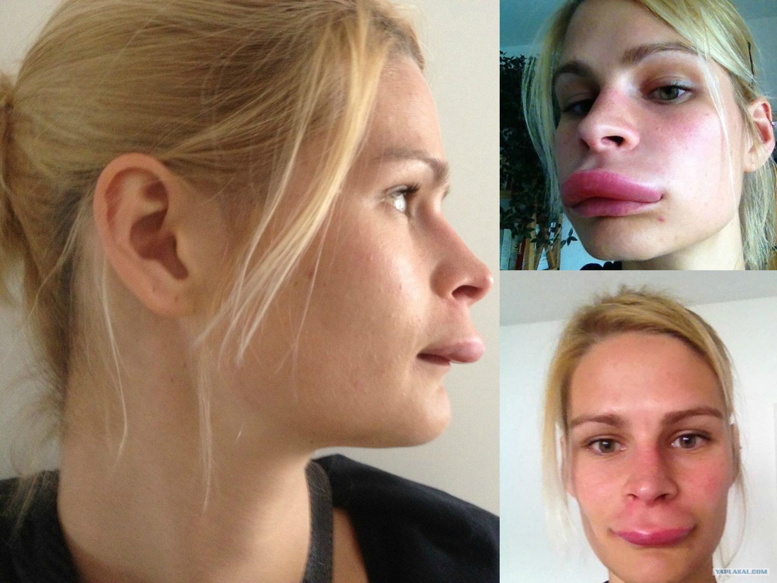 Quincke's edema: symptoms and treatment at home, photos of patients