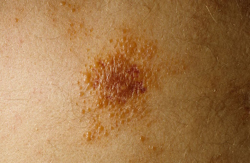 Meerdere endocriene neoplasie typen 1 en 2, oorzaken, symptomen, behandeling