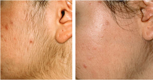 Hirsutismus bei Frauen: Symptome, Behandlung mit Intense Pulsed Light