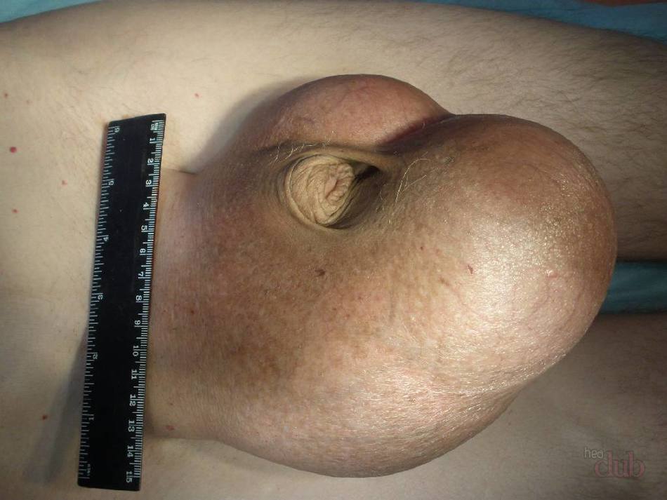 Orquitis en hombres: síntomas (foto) y tratamiento.