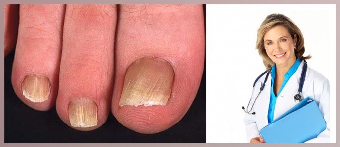 Hvilken læge behandler tåneglesvamp, hudlæge eller mykolog?
