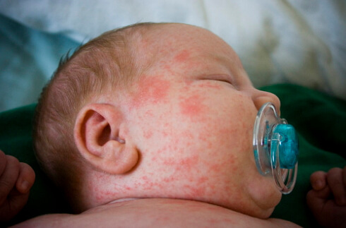 Allergien bei Neugeborenen