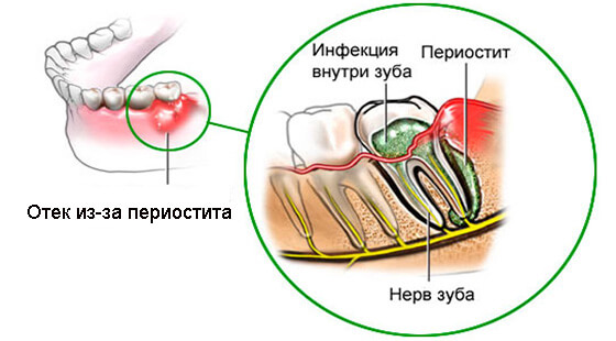 Periostitis( Entzündung der Knochenhaut): Formen und Behandlung