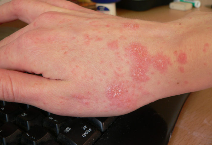 eksem