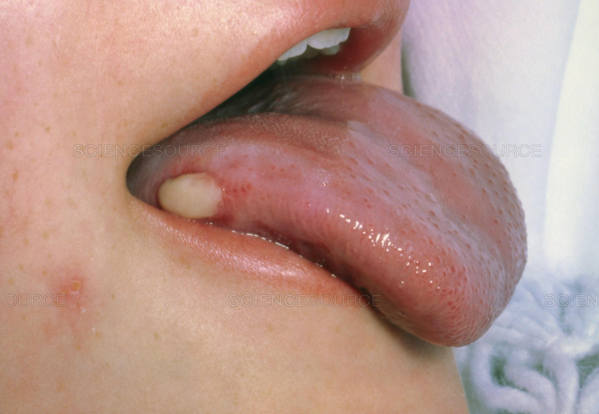 Mundkrebs: Ursachen, Symptome, Behandlung, Prognose