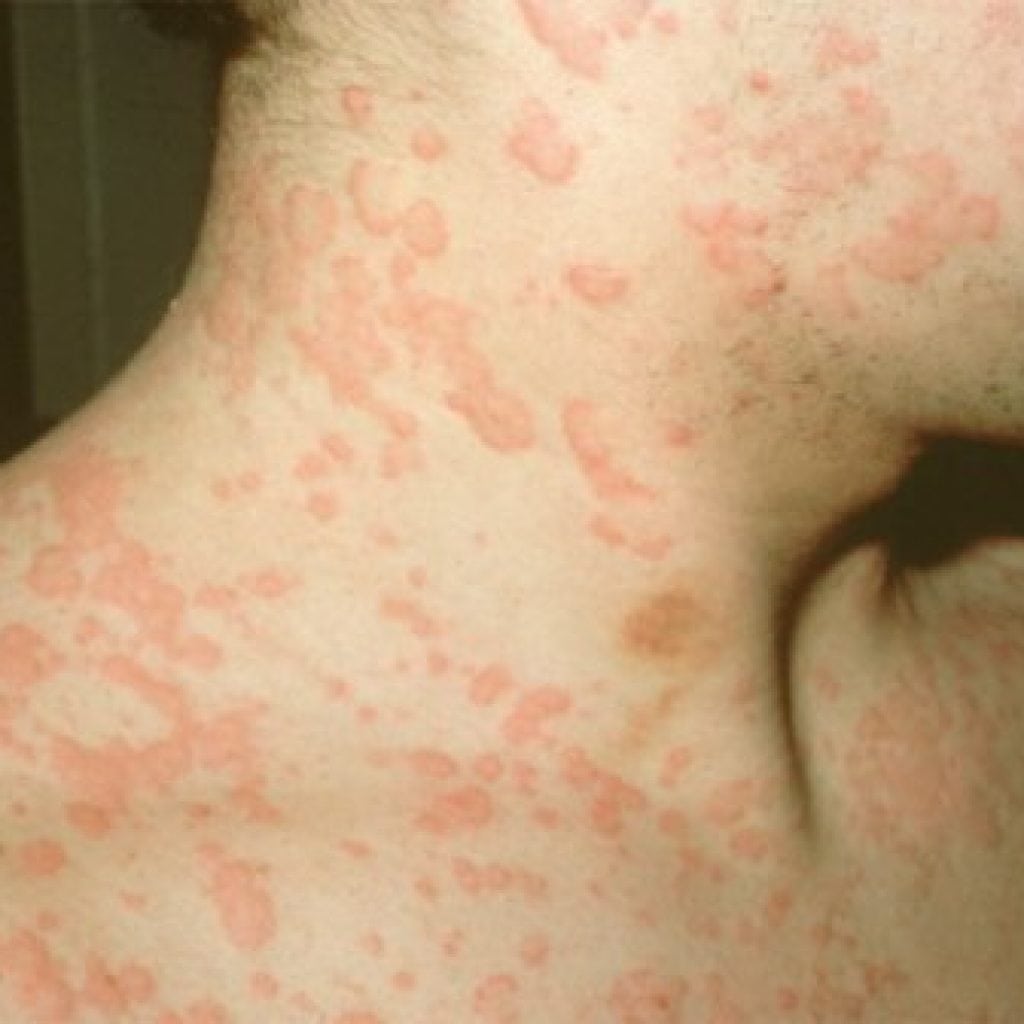 Food allergy in adults: symptoms and treatment, photos, nutrition