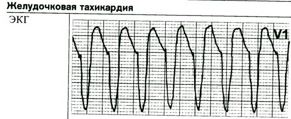 What to take with tachycardia