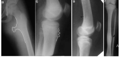 Exostosis: Ursachen, Symptome und Behandlung