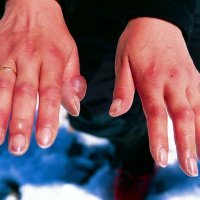 Behandling af frostskader af hænderne