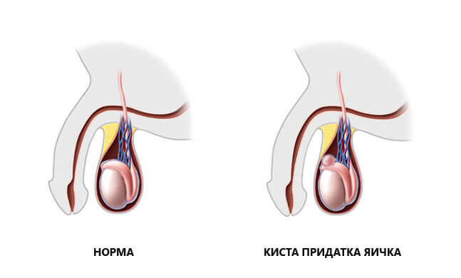Spermatocele: simptomi, vzroki, zdravljenje in možni zapleti