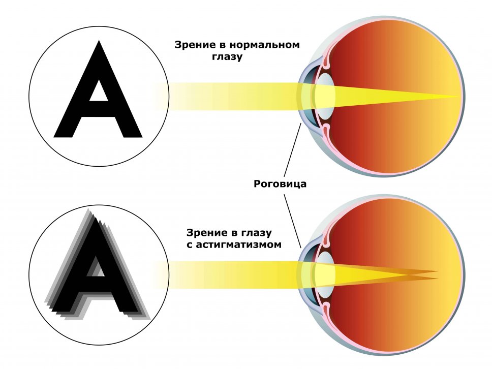 Astigmatism lastel: sümptomid, põhjused ja ravi