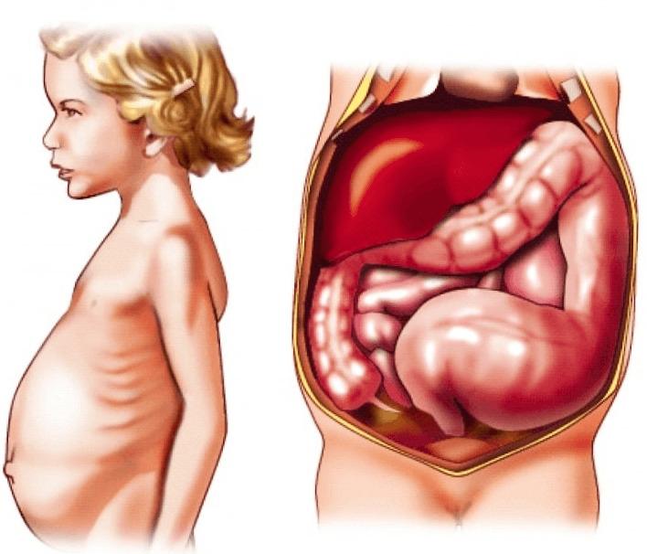 Morbus Hirschsprung: Was ist das, Ursachen, Symptome, Behandlung, Prognose