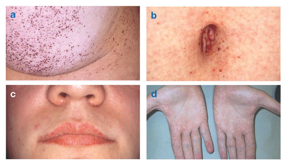 Lipoidose (Lysosomale Lipidspeicherkrankheit): Was ist das, Beispiele