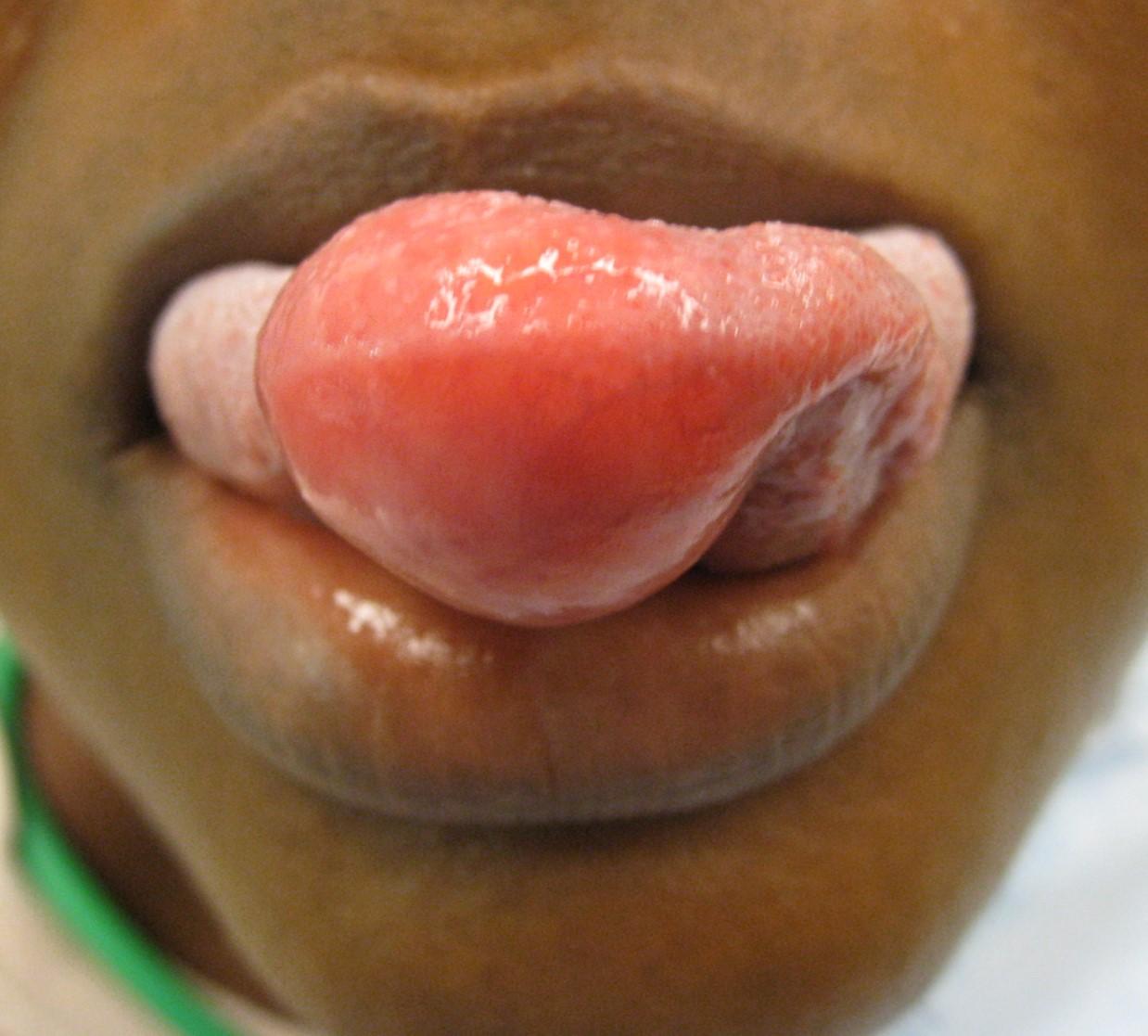 Macroglossia: wat is het, oorzaken, symptomen, behandeling